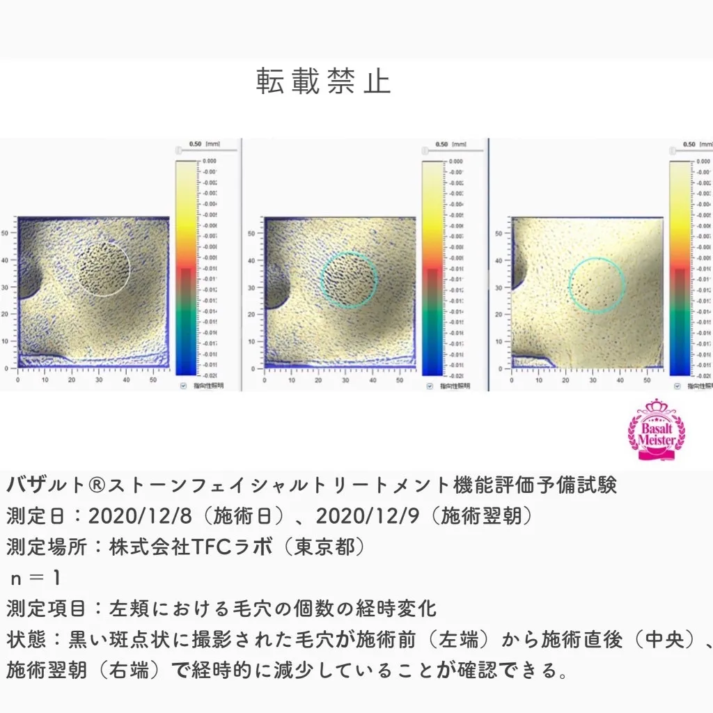 【宇都宮でバザルトストーンフェイシャル　ハイドロスプラッシュ　毛穴ケア　肌荒れ　ニキビに】